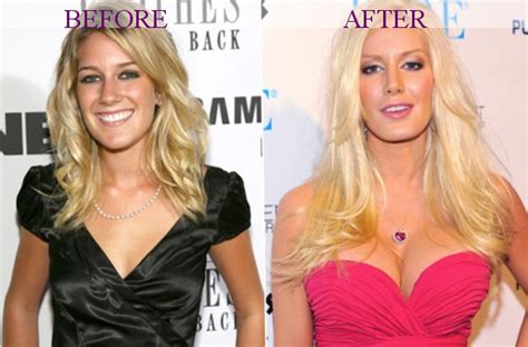 Celebrity Heidi Montag - plastic surgery, photos, video