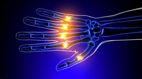 Metacarpophalangeal Joints Pain Anatomy for Medical Concept 3D Stock ...