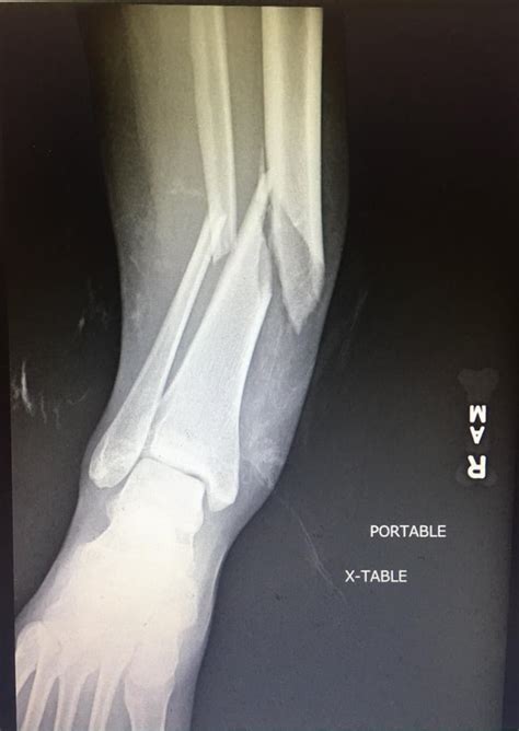 My recent tibia and fibula fracture : r/medizzy