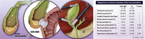 EUS-guided gallbladder drainage versus laparoscopic cholecystectomy for ...