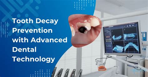 Tooth Decay Prevention with Advanced Dental Technology