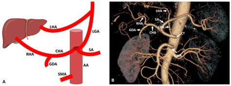 Diagnostics | Free Full-Text | Importance of Anatomical Variation of the Hepatic Artery for ...