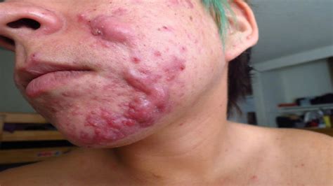 How To Get Rid Of Cystic Acne. - YouTube