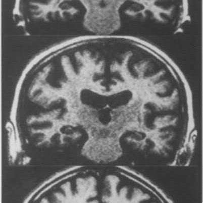 (PDF) Visual assessment of medial temporal lobe atrophy on magnetic ...