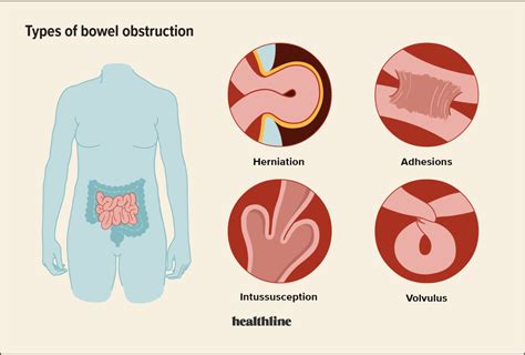 Female Bowel Obstruction Symptoms And Treatment Options | The Best Porn Website