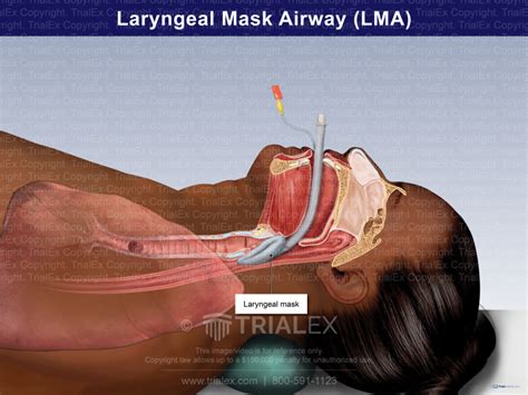 Laryngeal Mask Airway (LMA) - TrialQuest Inc.