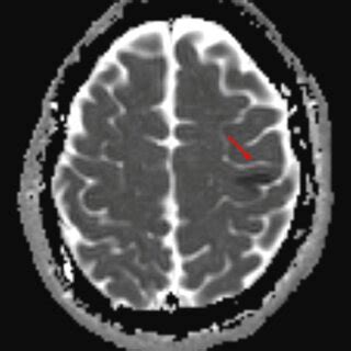 The ADC MRI image shows restricted diffusion with corresponding low ADC... | Download Scientific ...