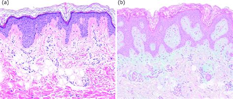 (a) An increase in mucin in the papillary dermis that displace collagen... | Download Scientific ...