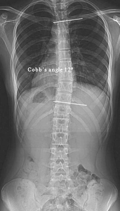 Postero-anterior x-ray of the whole spine showing a mil | Open-i