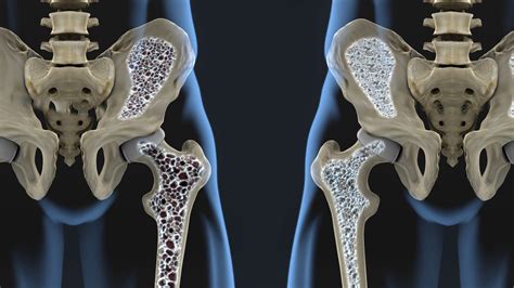 Osteoporosis: Risks, Symptoms and Treatment | Live Science