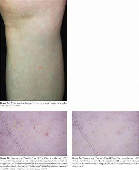 Unilateral Nevoid Telangiectasia Acquired Spider