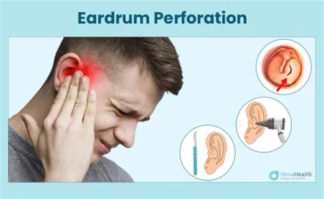 Perforated Eardrum - Symptoms, Causes, Treatment, Antibiotics