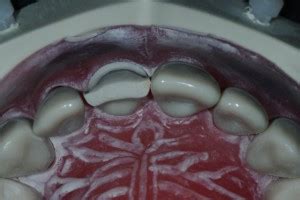 Labial Reduction (Classical Approach) – International Dentist Central