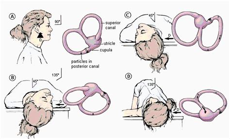 Elle Is For Living!: The Epley Maneuver