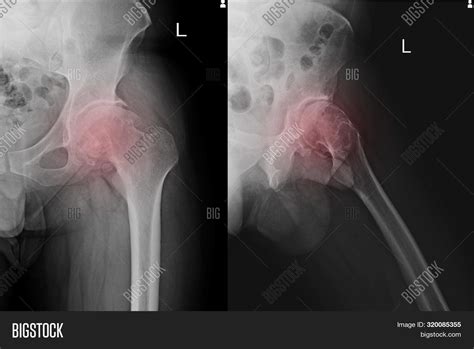 Hip X-ray Sclerosis Image & Photo (Free Trial) | Bigstock