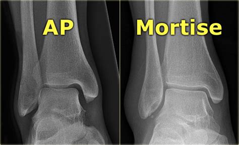 AP Projection- Ankle and AP Oblique Medial rotation-Mortise Joint Diagram | Quizlet