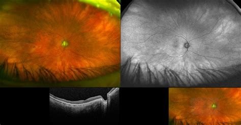 Silverstone - Retinoschisis with Foveal Attachment, RG, AF, OCT