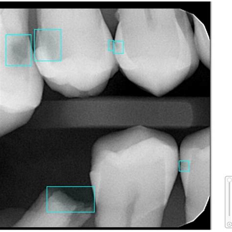 An example bitewing X-ray image with annotated carious lesions in the ...