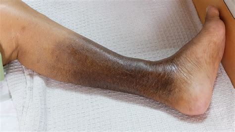 If These Legs Could Talk: Lipodermatosclerosis - Laurel Clinical