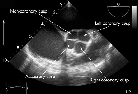 Aortic Valve Cusps Echo