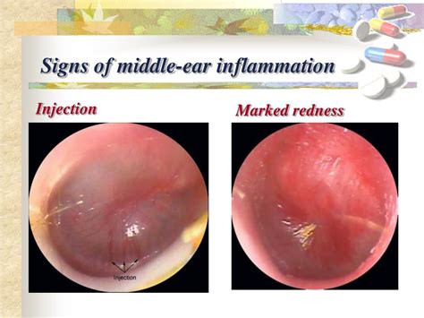 PPT - Acute Otitis Media PowerPoint Presentation, free download - ID ...