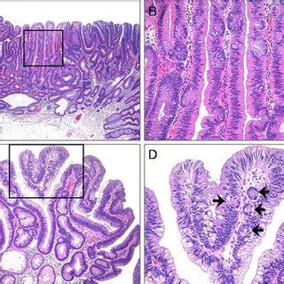 Conventional adenoma (CA) with a focal villous architecture. (A ...