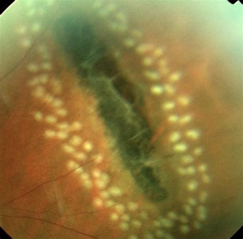 Peripheral retinal degeneration - Diagnosis - Video