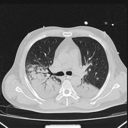 Air bronchogram | Radiology Reference Article | Radiopaedia.org