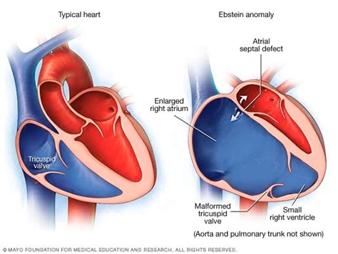 Tricuspid valve regurgitation - Symptoms and causes - Mayo Clinic