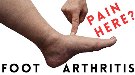 Foot Arthritis Pain: Most Common Signs and Symptoms - YouTube