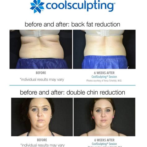 Coolsculpting Before and After: Results, Side Effects, and What to Expect - Must Read This ...