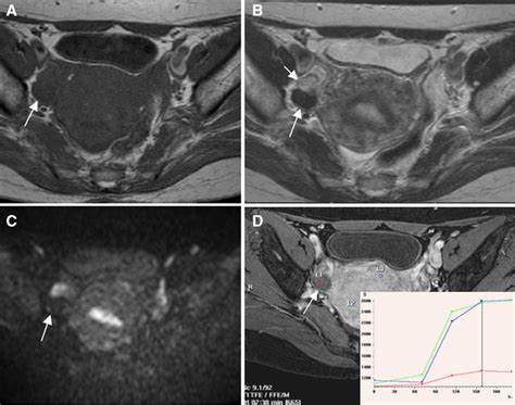 Magnetic resonance imaging features of ovarian fibroma, fibrothecoma, and thecoma | SpringerLink