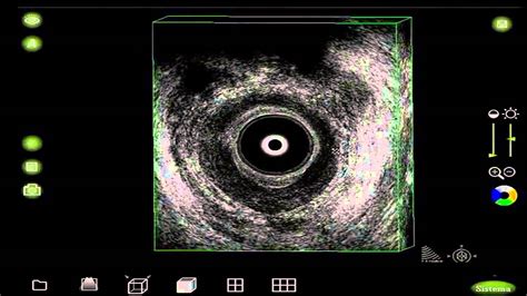 Transrectal ultrasonography of anorectal diseases: advantages and ...