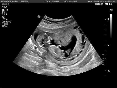 12 Week Ultrasound Gender Boy