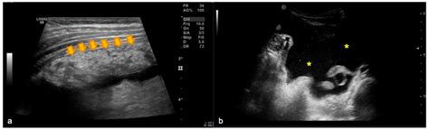 Diagnostics | Free Full-Text | The Omental Cake Sign in Pediatric Tuberculosis