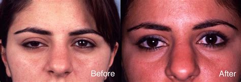 Eyelid Case Study | Beverly Hills Blepharoplasty Cases