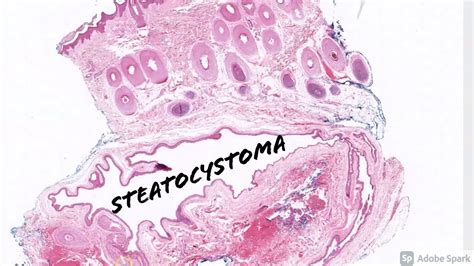 Steatocystoma: 5-Minute Pathology Pearls - YouTube