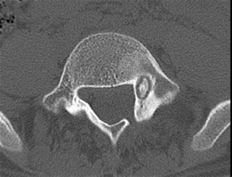 Pathologic Scoliosis - Spine - Orthobullets