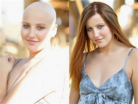 Wigs for Cancer Patients in Delhi India | Men Women Chemotherapy Wigs