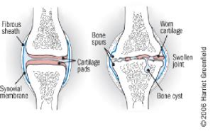 Knee Osteoarthritis - Physiopedia