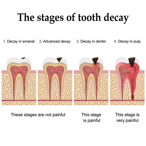 Stages of Tooth Decay | Dental in Rigby | Cedar Creek Dental