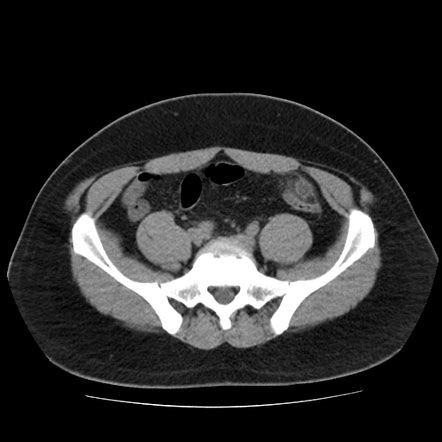 Epiploic appendagitis | Radiology Case | Radiopaedia.org