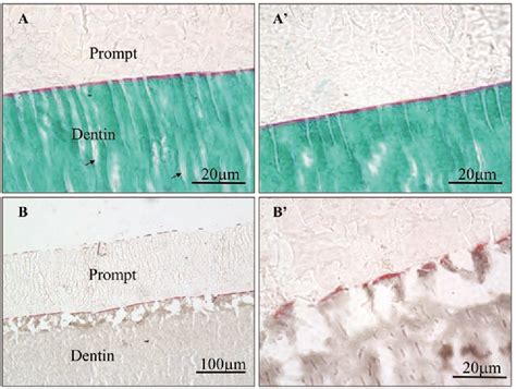 Figure 1 from Continuing Etching of an All-in-One Adhesive in Wet Dentin Tubules | Semantic Scholar