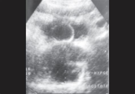 Abdominal USG showing prostatic abscess | Download Scientific Diagram