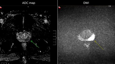 The power of MRI/US biopsy in prostate cancer diagnosis | Philips Healthcare