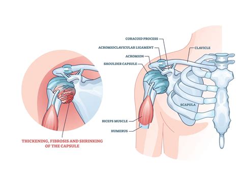 Dealing With Acromion Pain With The Best Exercises For Relief ...