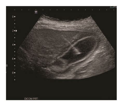 IR-guided cholecystostomy tube placement and drainage and irrigation of ...