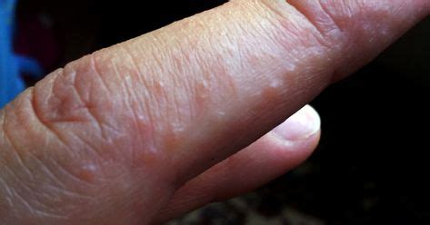 7 Dermatitis herpetitis ideas | dermatitis, dermatitis herpetiformis, gluten allergy