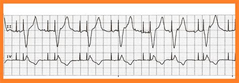 Float Nurse: Practice EKG Strips 405