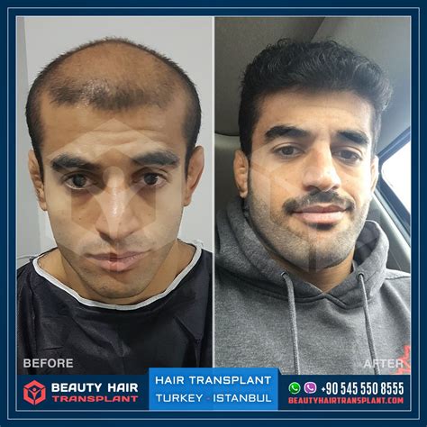 Hair Transplant in Turkey Before After | Hair Transplantation Results